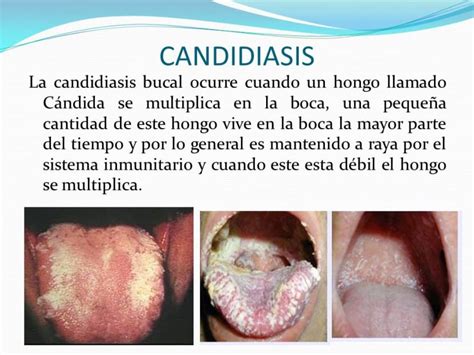 Candidiasis vaginal: qué es, causas, síntomas y tratamiento